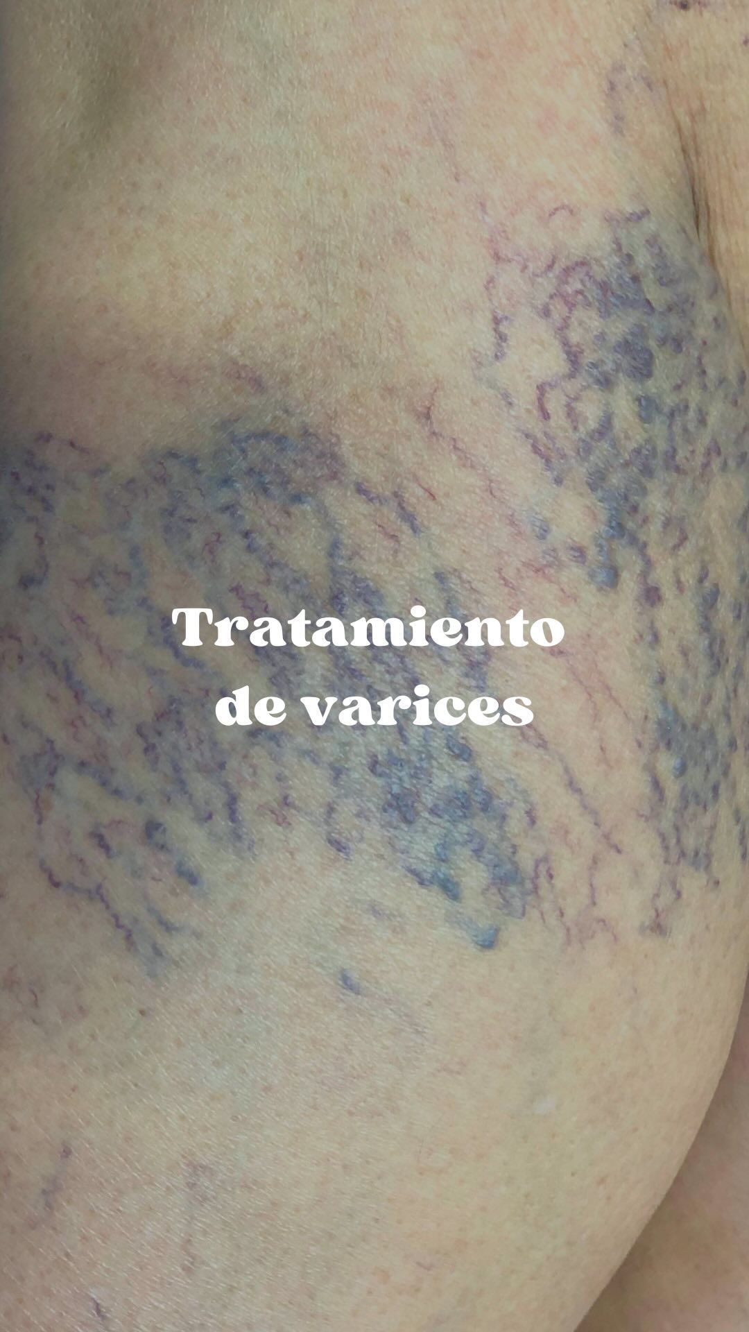 Tratamiento de várices en Posadas